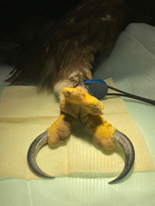 Amputation des deux doigts nécrosés